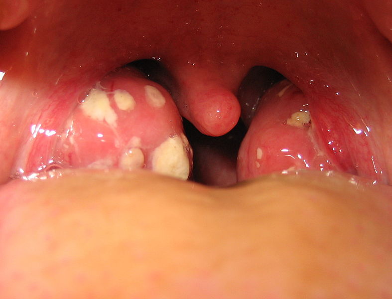 Credit: Tonsillitis Article on Wikipedia